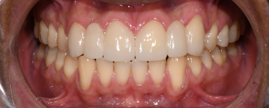 Bridges 6-8, 9-11 After