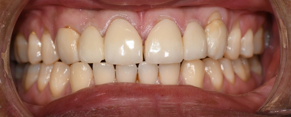 Bridges 6-8, 9-11 Before