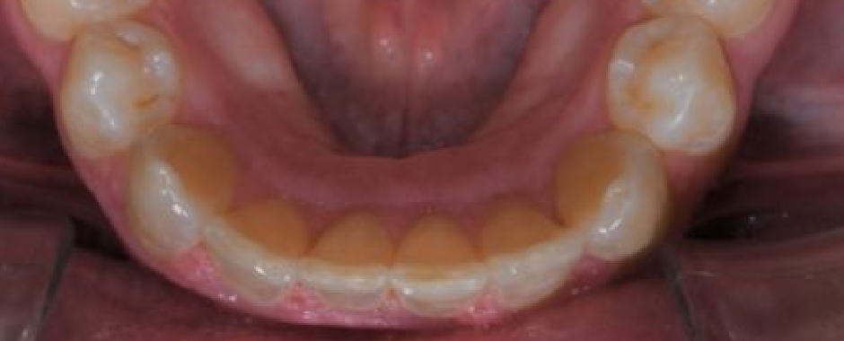 Clear Aligners 1 After