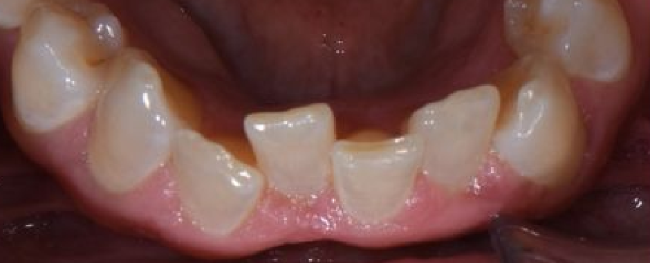 Clear Aligners 1 Before