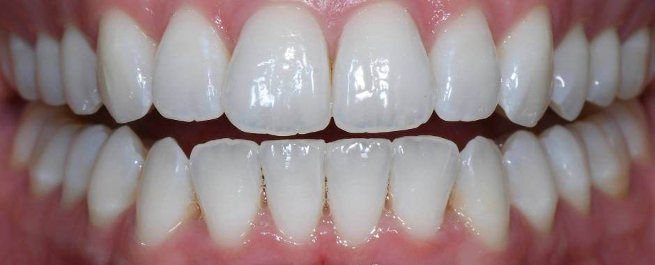Clear Aligners (3) After