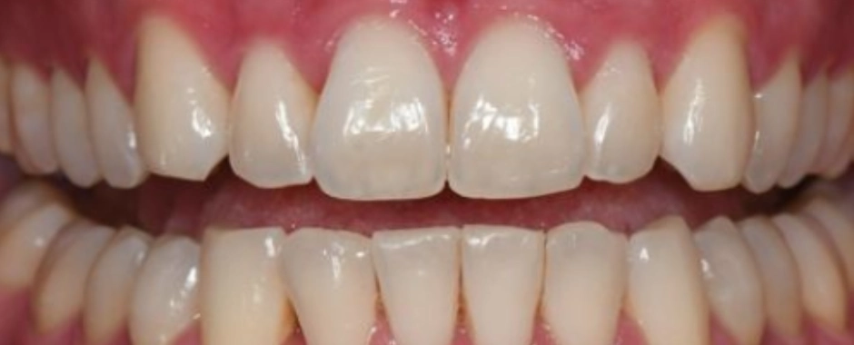 Clear Aligners After