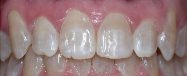 Clear-Aligners After