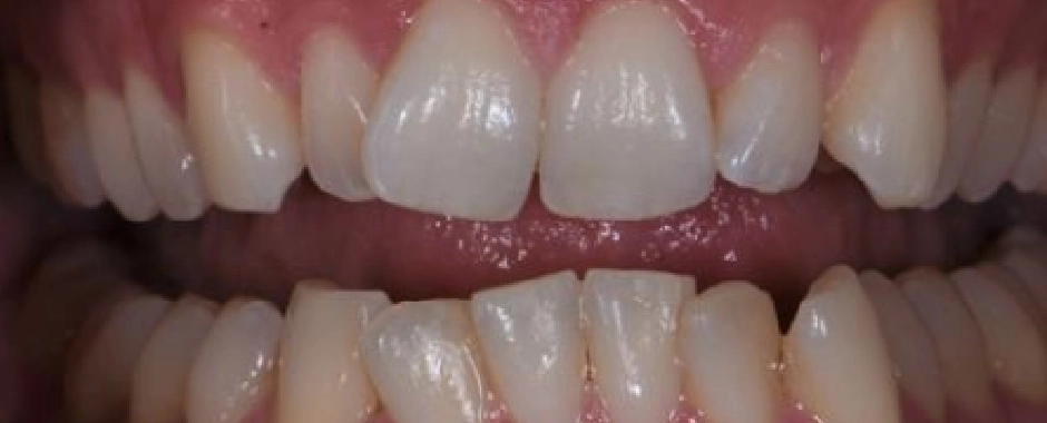 Clear Aligners Before