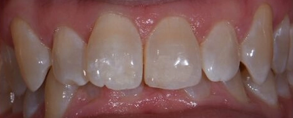 Clear-Aligners Before