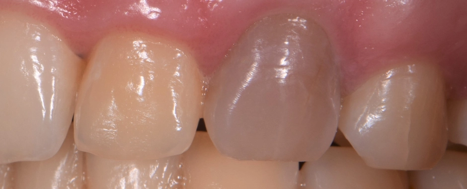 FLD - Allyson Ryan Before