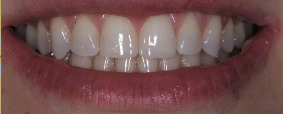 FLD - Lindsey Hicks After