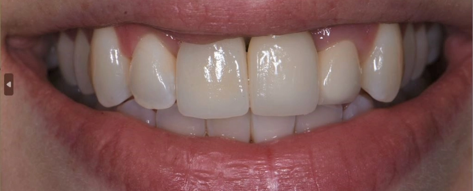 FLD - Lindsey Hicks Before