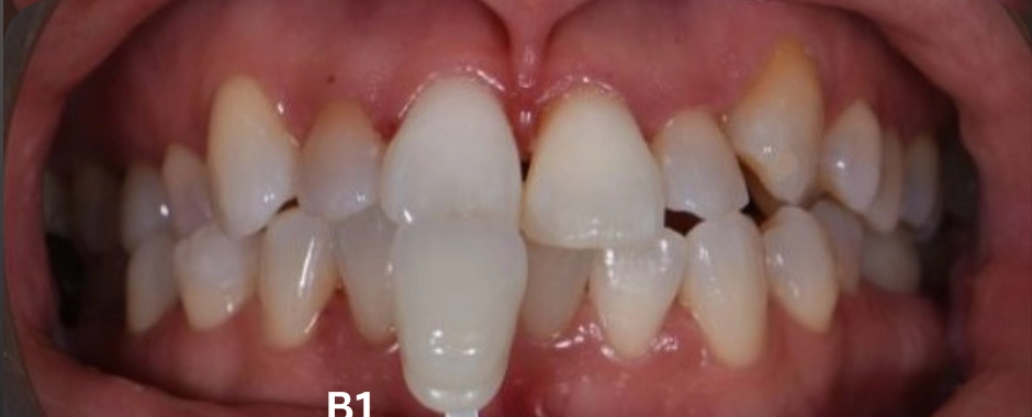 FLD - Marsha Slade After