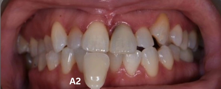 FLD - Marsha Slade Before