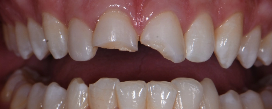 Fillings 8, 9 Before