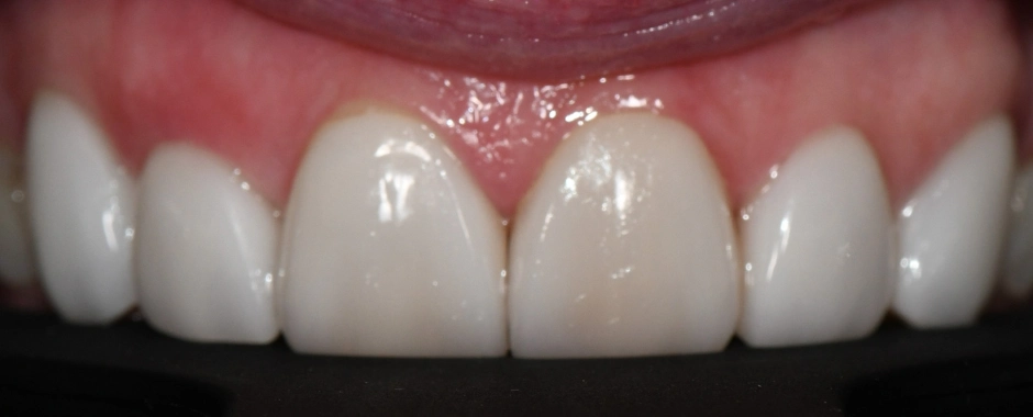 Veneers (1) After
