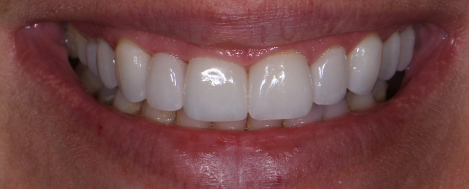 Veneers 4-12 After