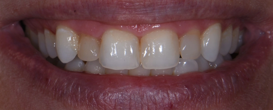 Veneers 4-12 Before