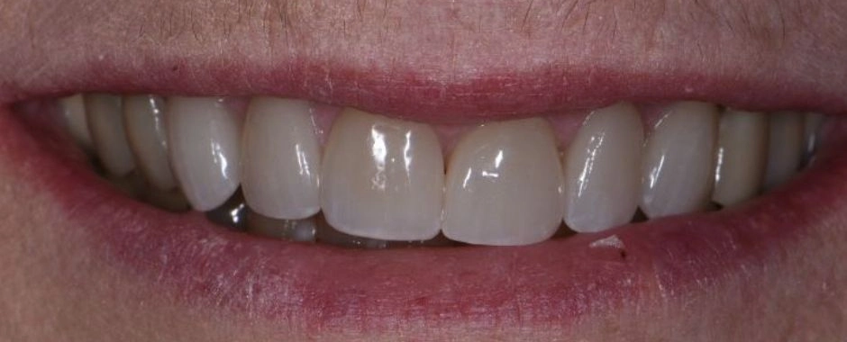 Whitening After
