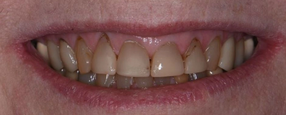 Whitening Before